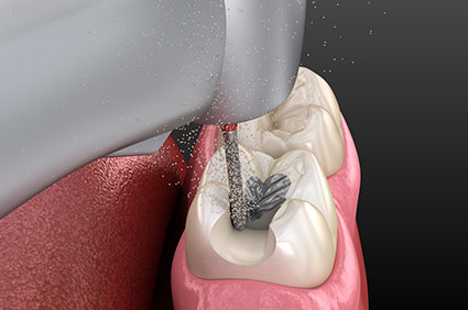 diagram of removal of amalgam on top of teeth