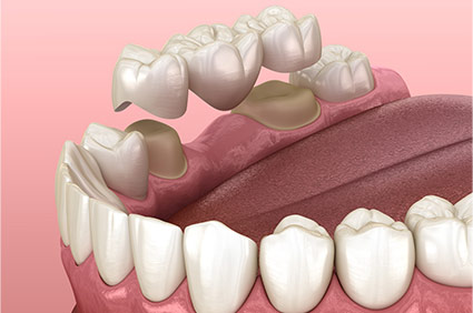 Diagram of dental bridge in place over 3
