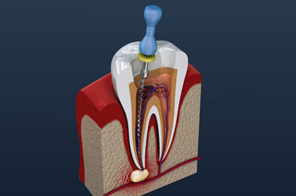 Diagram of a root canal, drilling into the affected tooth